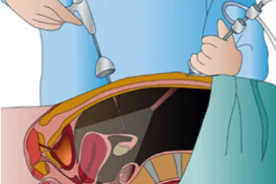 Laparoscopic Hysterectomy