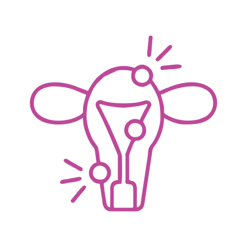 Endometriosis | Image